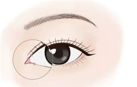 開(kāi)眼角術(shù)后可以抽煙嗎